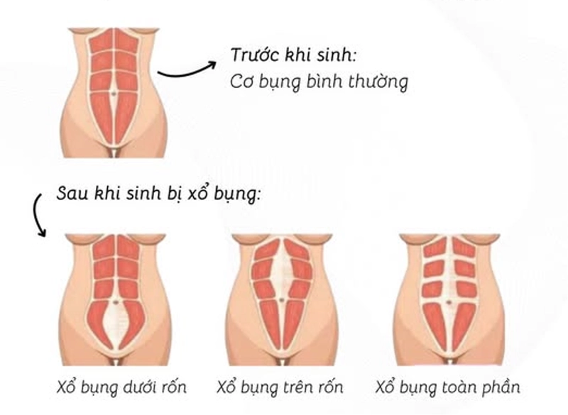 Tình trạng xổ bụng sau sinh khá thường gặp