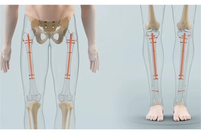 Kéo dài chân tăng chiều cao tuổi 30 liệu có hiệu quả?