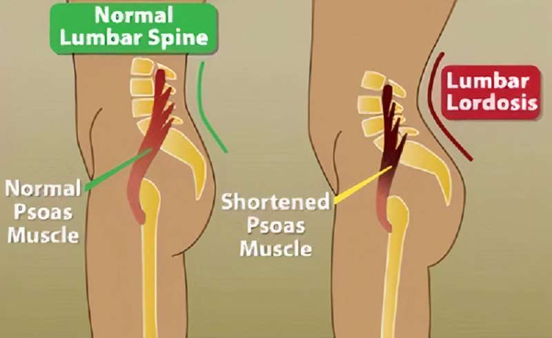 Bài tập dành cho người võng lưng