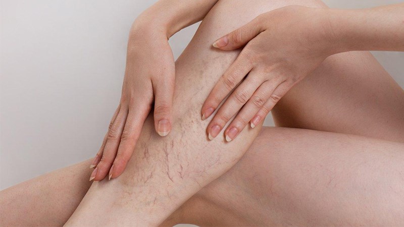 Chân bị giãn tĩnh mạch