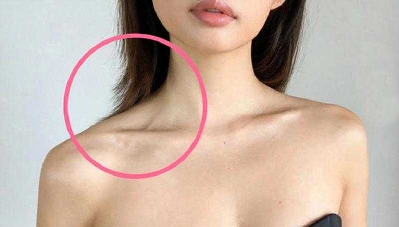 Tổn thương vùng xương quai xanh bạn cần phải làm thế nào?